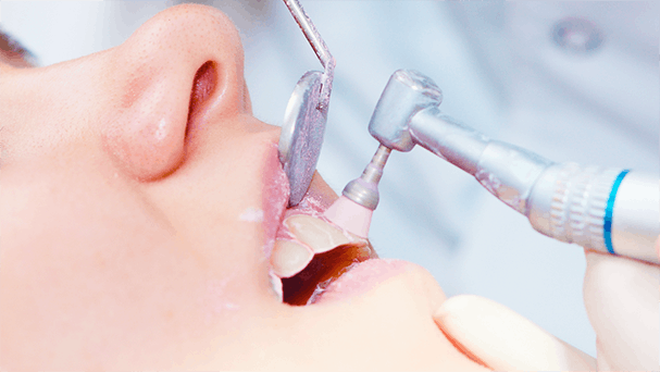 tratamento de polimento dental